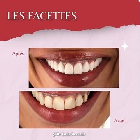 Facettes dentaires – avant / après
